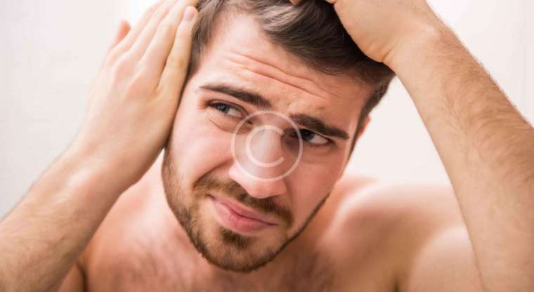 Going Bald Too Young? Top Tips From The Experts!